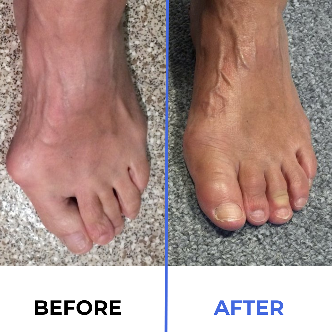 Healthguard™ Bunion Corrector