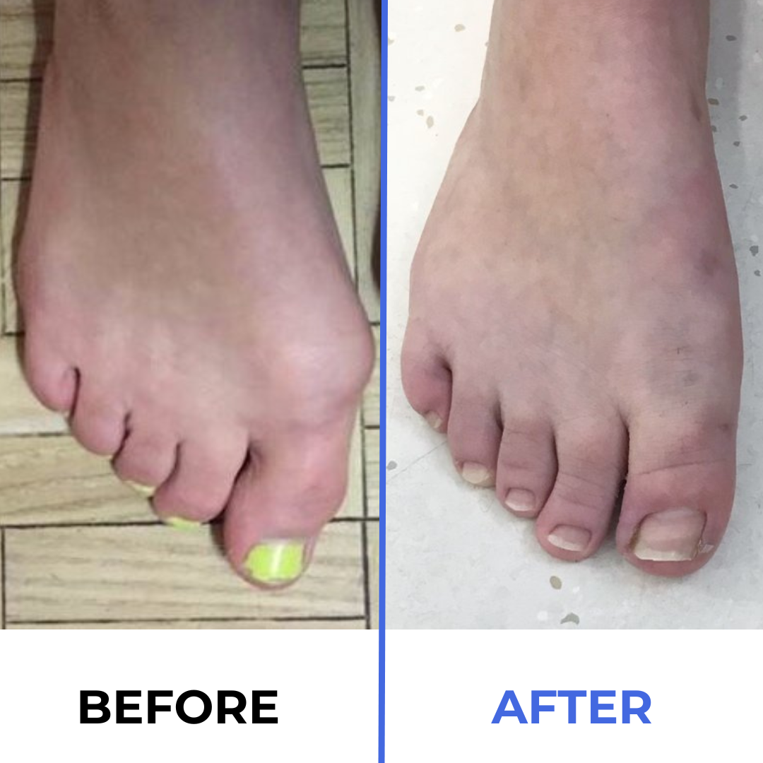 Healthguard™ Bunion Corrector